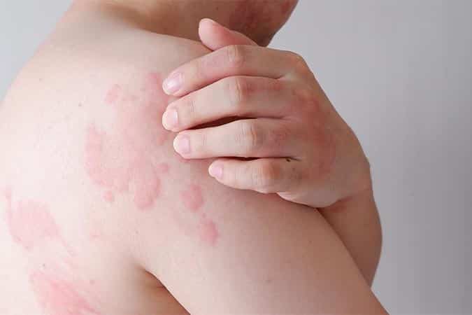 접촉성 피부염 유발 원인 8가지