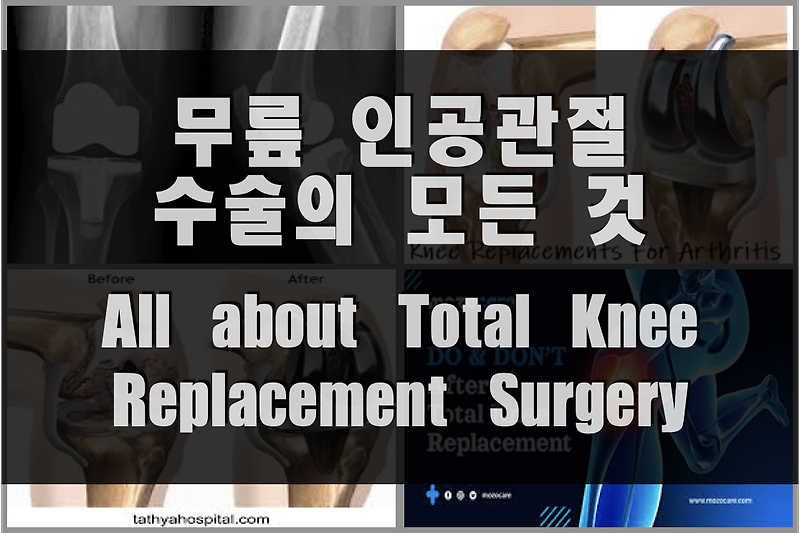 무릎 인공관절수술의 모든 것 (대상, 방법, 시간, 비용, 회복 및 재활운동법 등)