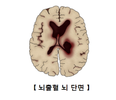 뇌출혈 전조 증상 과 뇌출혈 후유증
