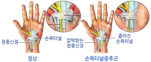 손목 터널 증후군 증상 4가지