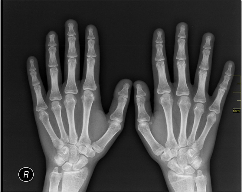 손뼈 X-ray 사진