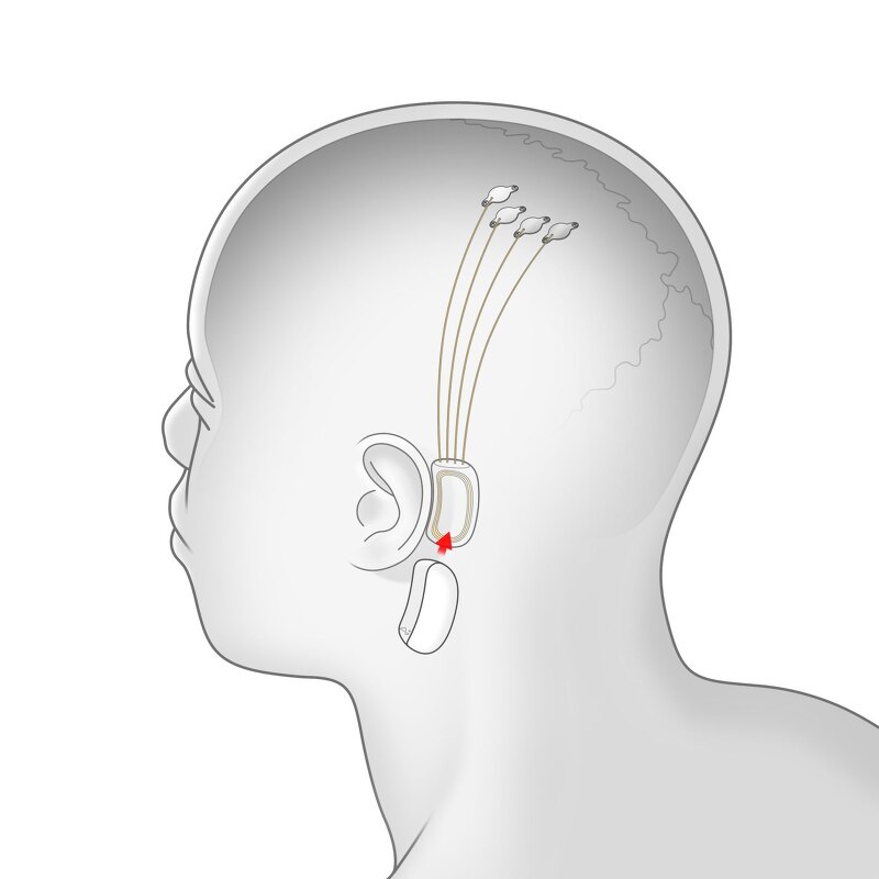 엘론 머스크의 Neuralink가 실현하는 ‘인간의 뇌'와 컴퓨터의 연결