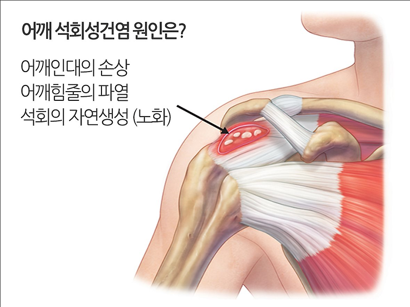 어깨통증원인 8초만에 잡는법