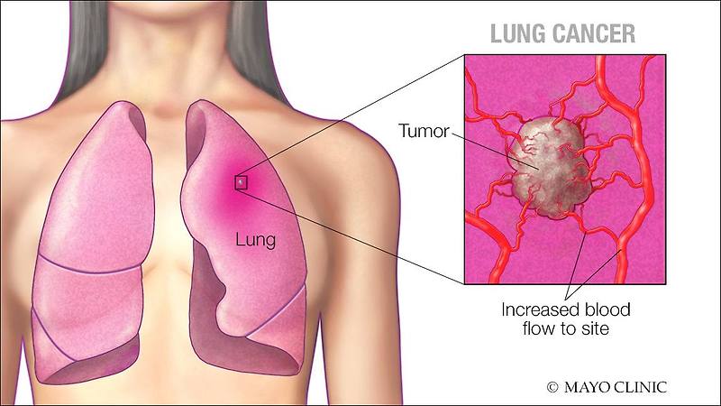월경과 폐경이 일찍 시작되면 폐암 위험이 높아질 수 있습니다.