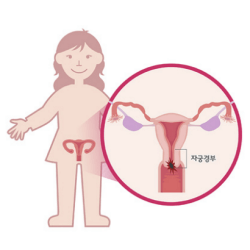 자궁경부염증 자궁출혈 (자궁경부암 원인 및 증상)
