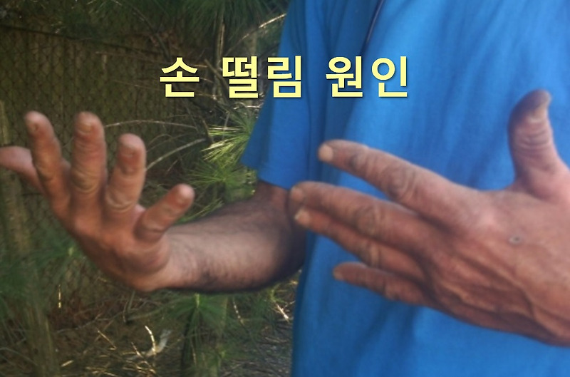 손 떨림 원인과 손 떨림 증상 치료 방법