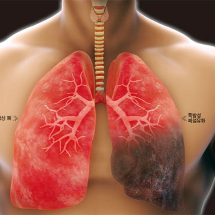 폐렴 증상 및 폐렴 예방접종 미리 준비