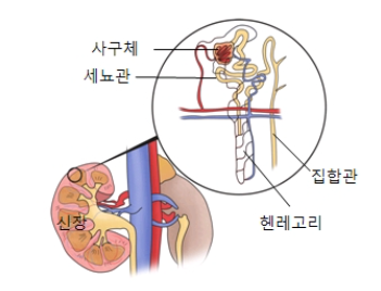 만성신부전 증상 과 원인