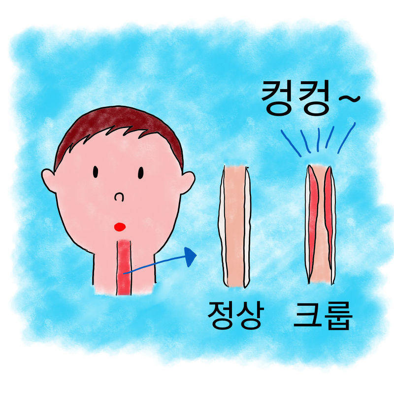 크룹, 크루프(급성 폐쇄성 후두염), 컹컹 기침