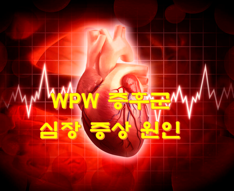 WPW 증후군 심장 증상 원인