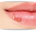 입술 포진, 구순 포진 증상 및 원인