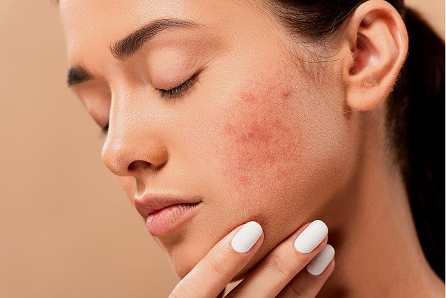 얼굴 홍조 원인 및 홍조 피부 악화 요인 & 홍조 피부관리 방법