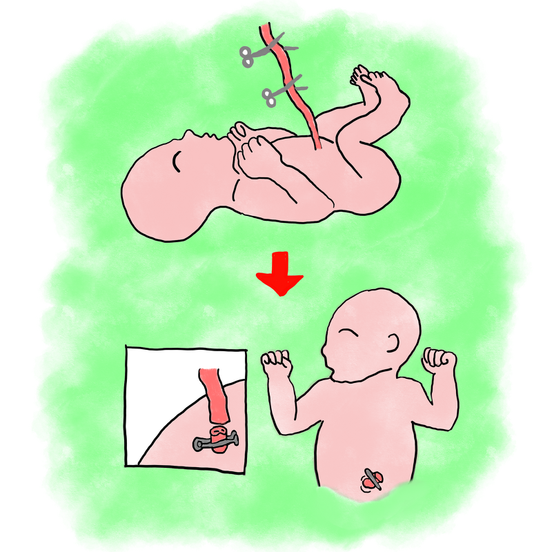 신생아 배꼽 육아종, 신생아 배꼽 관리 어떻게 할까요?