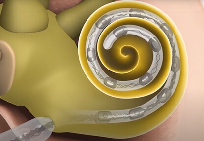 [연구] 3D 프린팅으로 사용자의 달팽이관(인공와우) 이식 개선