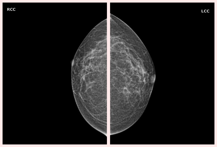 건강 검진 - 유방 촬영 Mammography [건강 보험 무료 암 검진 유방암 검사]