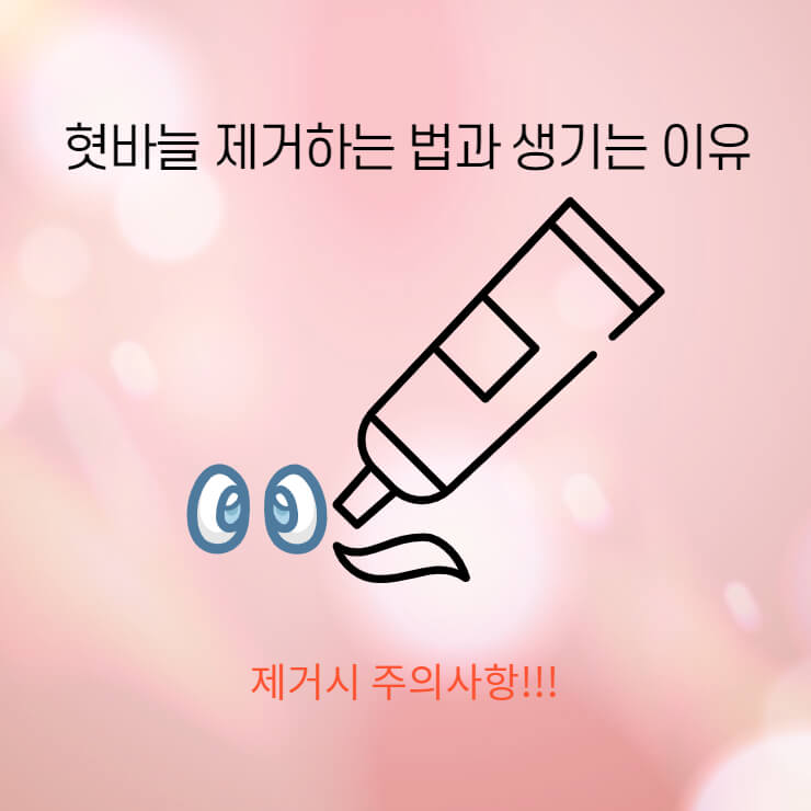 혓바늘 제거하는 법과 생기는 이유는 무엇일까요?