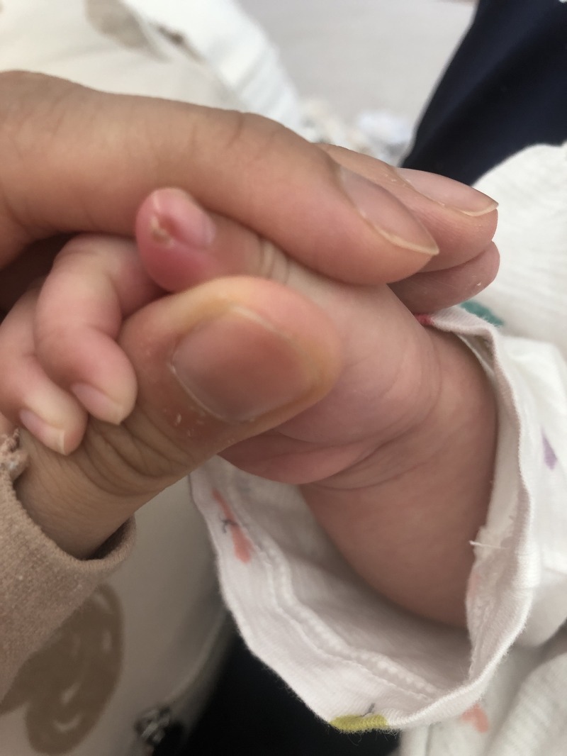 [육아 이야기] 아기 손톱 및 염증(고름) 치료 - 에스로반 연고 도포