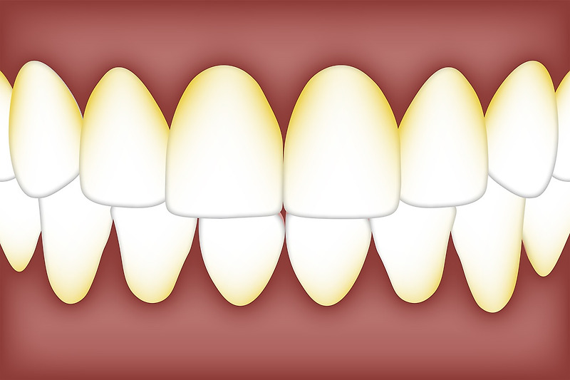 치아 스케일링 의료보험 나이와 주기, 효과는 어떻게 될까?