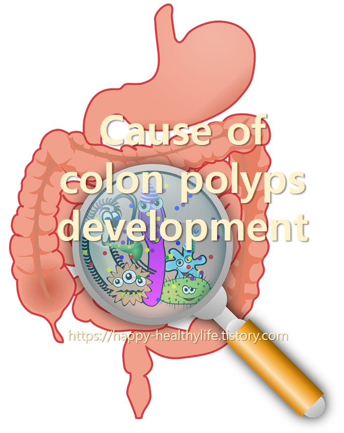 Causes of colon polyps and types of colon polyps