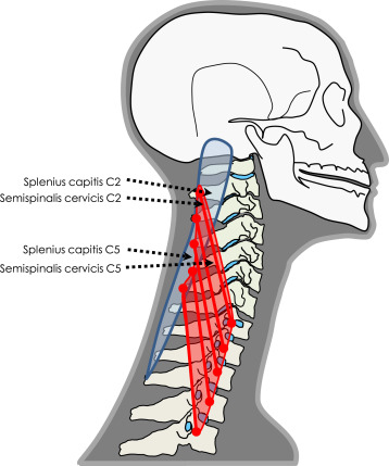 Semispinalis cervicis&capitis(경반극근,두반극근) - 관련 스포츠,기시,정지,작용,혈관,신경