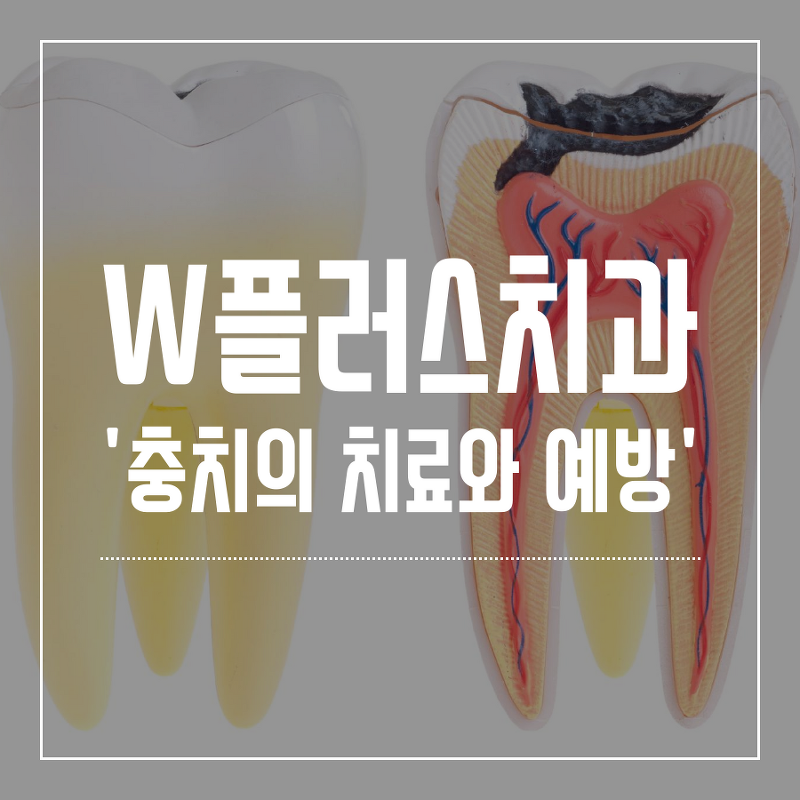 인천삼산동치과 충치? 치아우식증의 치료와 예방
