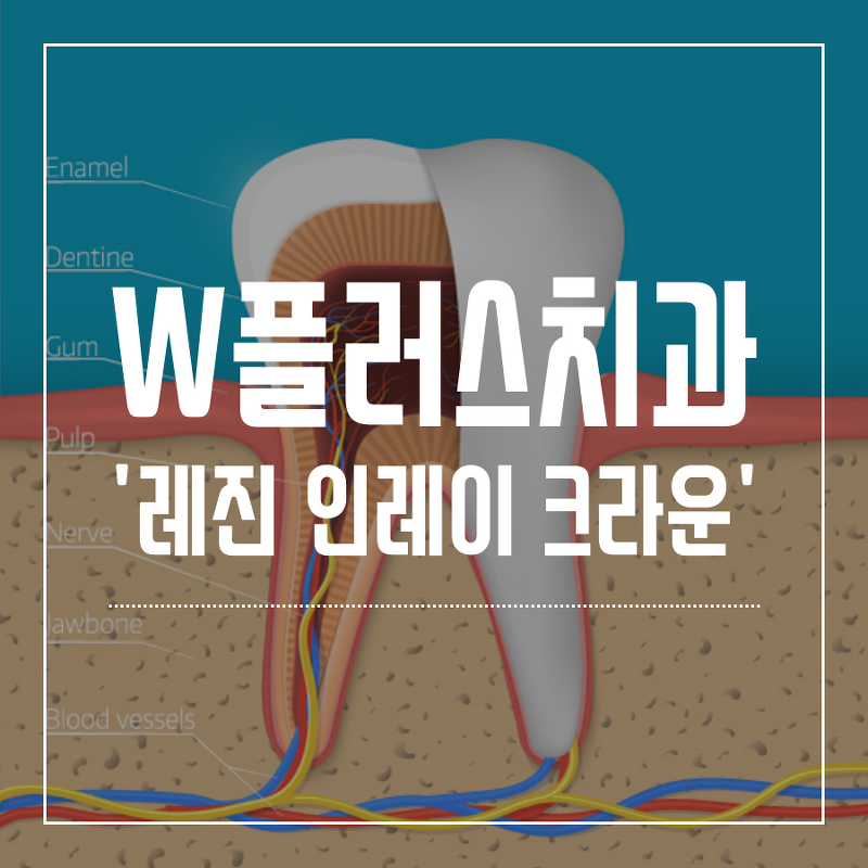 인천삼산동치과 레진 인레이 크라운 치아우식증 치료