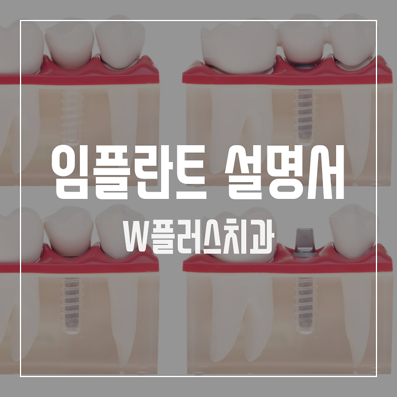 인천삼산동치과 ‘ #임플란트 (Dental Implants) ’