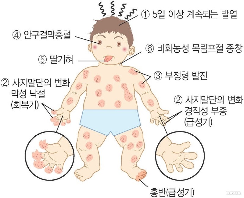 [의학정보] 가와사키병 [ Kawasaki disease ] 의 원인과 증상