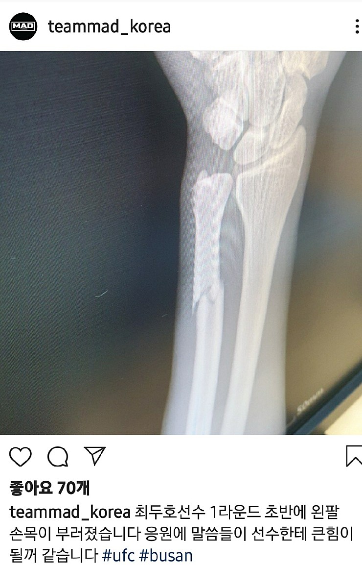 UFC 부산 최두호 손목 x-ray 골절 사진