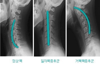 일자목 ‧ 거북목) 원인과 예방법 ‧운동 및 스트레칭