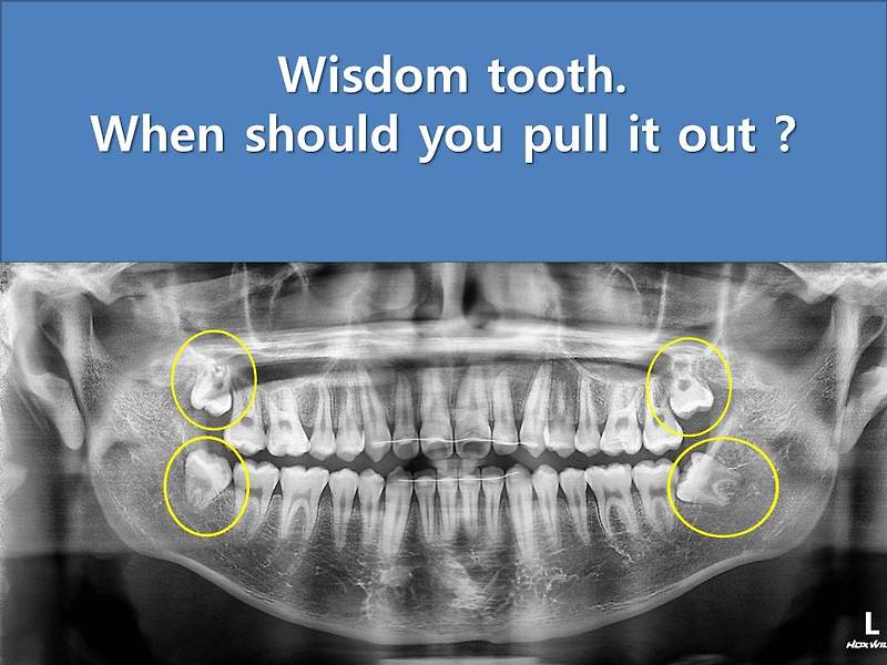 Wisdom tooth. When should you pull it out?