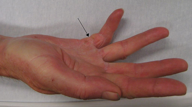 방아쇠수지(trigger finger, Trigger Finger Disorder) 치료방법