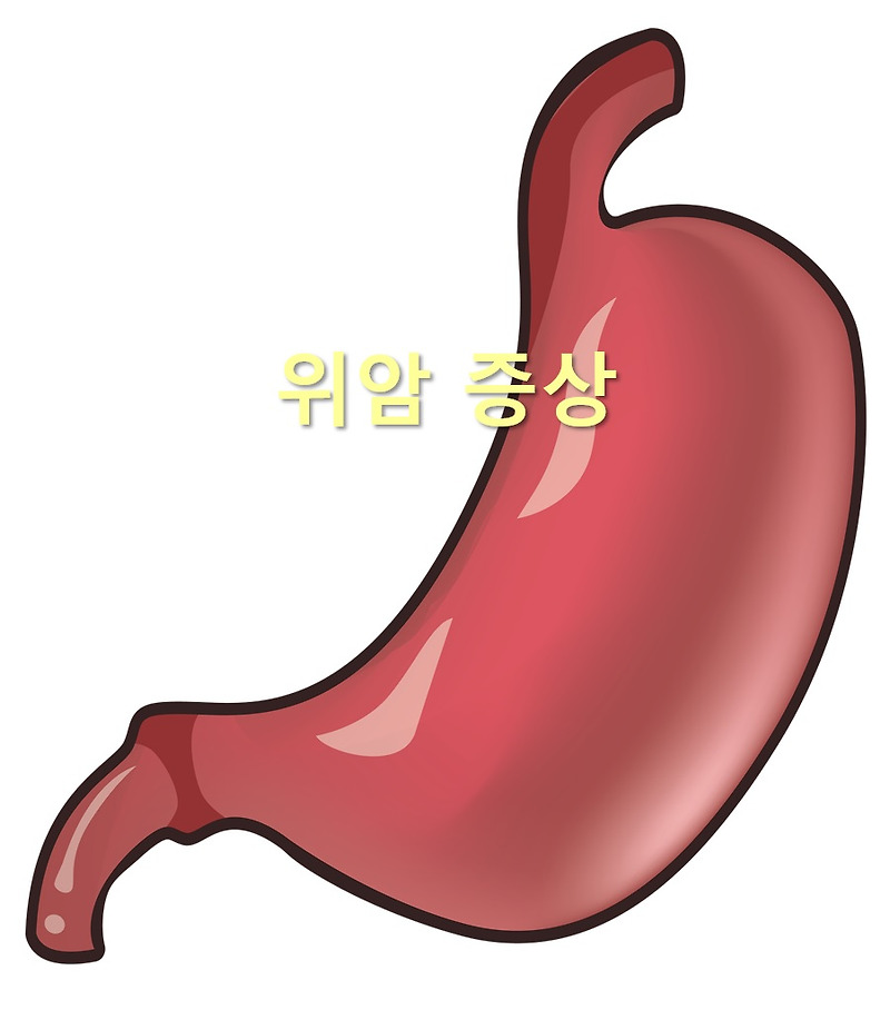 위암 증상과 위암 4기 생존율