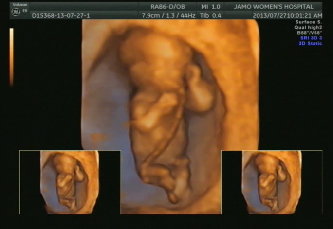 임신 12주 5일차 입체 초음파검사 -- 1차 기형아 검사 결과