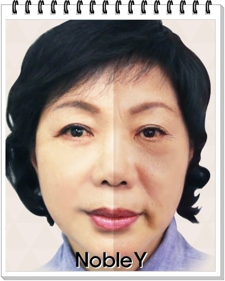 얼굴주름 볼처짐 개선은 안면거상수술이다