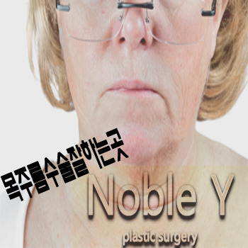 노블와이성형외과의 목거상술 방법과 회복기간 알아보기!