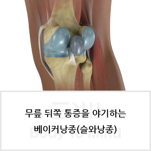 무릎 뒤쪽 통증을 야기하는 베이커낭종(Baker’s Cyst)·슬와낭종(Popliteal Cyst)