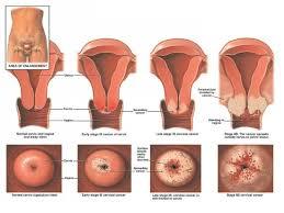건강한 자궁을 위해 신경써야할 자궁경부암 증상