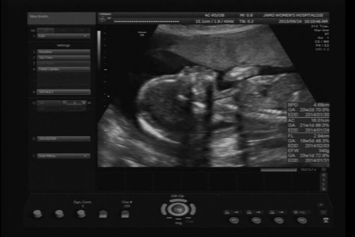 임신 20주 -- 5개월 초음파사진 검사 결과, 조리원 탐방