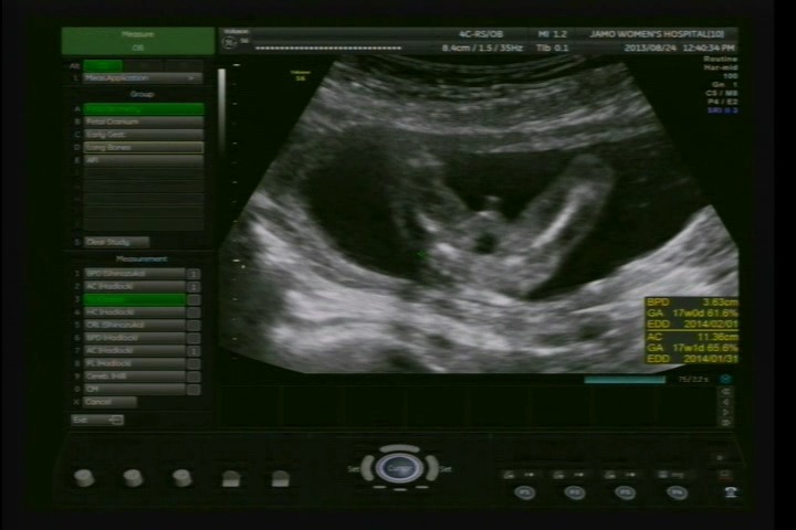 임신 17주차 -- 2차 기형아 검사 성별 확인