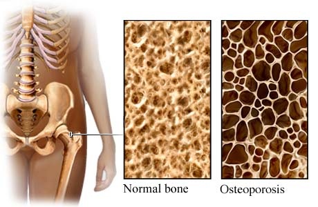 중년의 고민거리 뼈가 약해지는 골다공증 증상과 원인, 치료