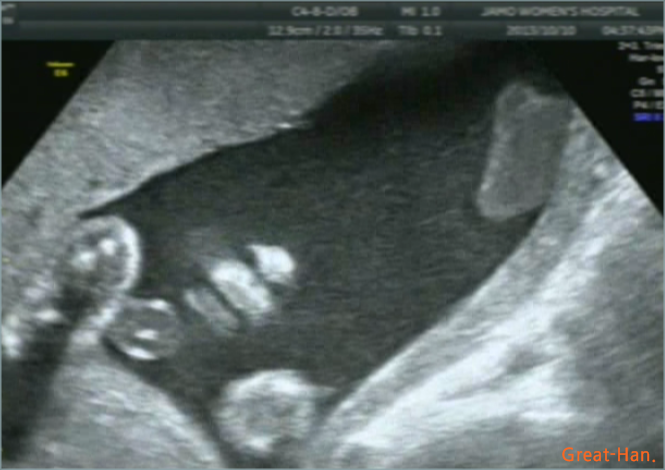 임신 23주 3일 -- 정밀초음파검사 결과, 비용