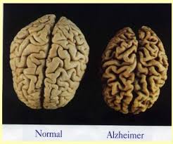 기억력 감퇴로 시작하는 치명적인 병, 알츠하이머 원인과 증상