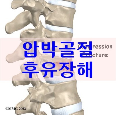 허리 압박골절 후유장해 지급기준 및 평가검토!