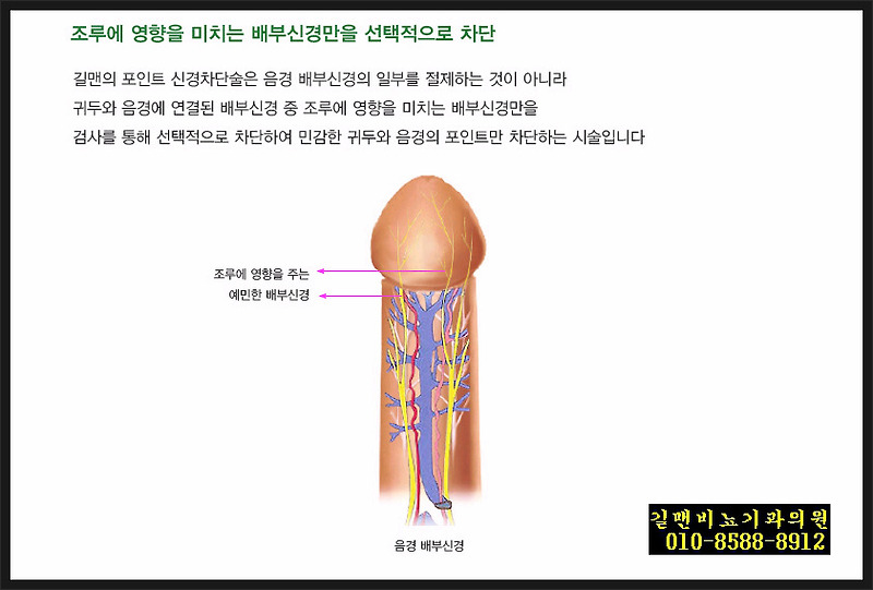 조루증의 선택적 치료방법 - 포인트신경차단술