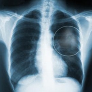 폐암 초기증상, 폐암 증상으로 조기에 폐암 발견
