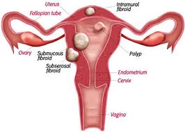 장기간에 걸쳐 진행되는 자궁암 초기 증상