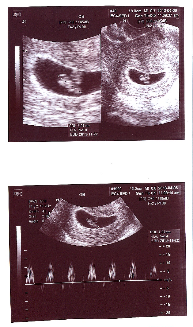 임신확인... 아기 심장이 뛴다.