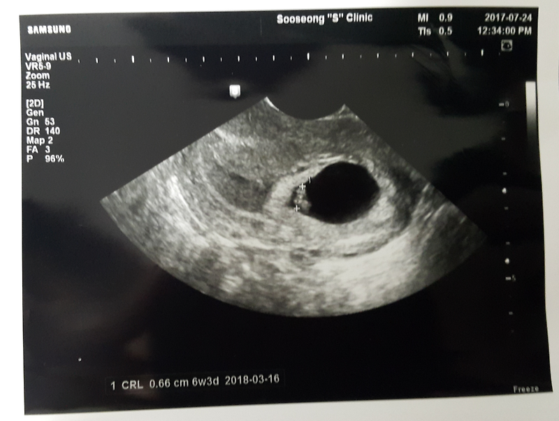 임신6주+3일 태아 땡큐의 심장박동