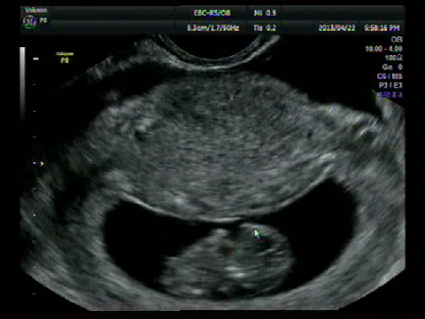 김해 프라임여성의원에서 찍은 임신 9주 초음파 사진과 동영상